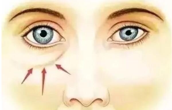 眼袋的四種類型