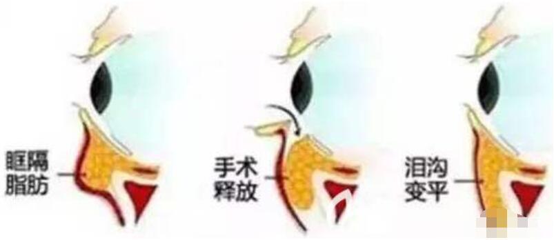 眶隔釋放去眼袋手術(shù)原理