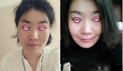 北京和諧美麗匯醫(yī)療美容面部輪廓案例