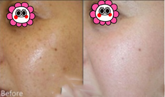 北京和諧美麗匯醫(yī)療美容激光祛斑案例