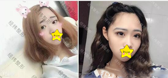 樂山經(jīng)緯整形美容醫(yī)院雙眼皮真人案例