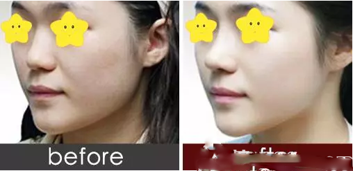 樂山經(jīng)緯醫(yī)療美容醫(yī)院隆鼻術(shù)后果圖