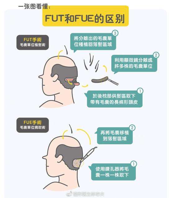 【盤點(diǎn)】FUT有痕頭發(fā)種植和FUE微創(chuàng)植發(fā)技術(shù)哪里截然不同？