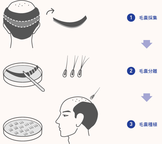 【盤點(diǎn)】FUT有痕頭發(fā)種植和FUE微創(chuàng)植發(fā)技術(shù)哪里截然不同？