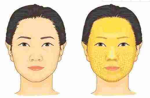 做完脂肪填充面部后擔(dān)心終成豬頭？消腫小妙招~