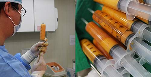 做完脂肪填充面部后擔(dān)心終成豬頭？消腫小妙招~