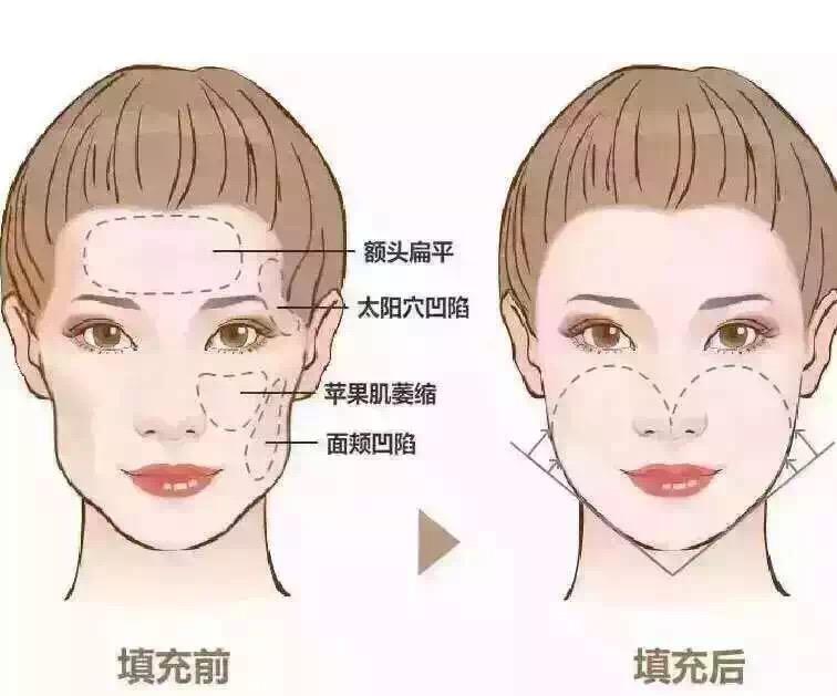 做完脂肪填充面部后擔(dān)心終成豬頭？消腫小妙招~