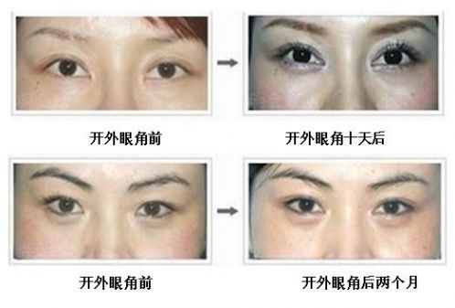 開眼角手術(shù)能給你們帶來什么作用？不單單是放大眼睛哦~