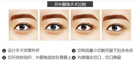 開眼角手術(shù)能給你們帶來什么作用？不單單是放大眼睛哦~