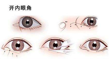 開眼角手術(shù)能給你們帶來什么作用？不單單是放大眼睛哦~