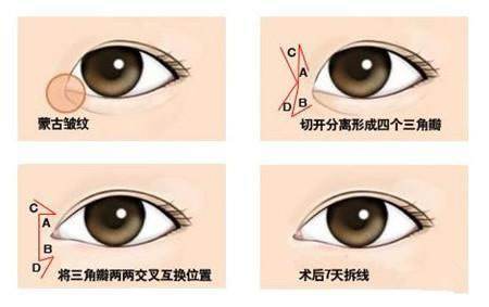 開眼角手術(shù)能給你們帶來什么作用？不單單是放大眼睛哦~