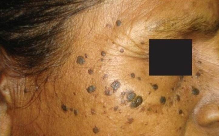 老年斑的形成是因?yàn)楦巍⑵?、腎三臟功能的衰退