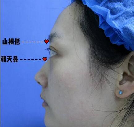 朝天鼻矯正手術(shù)