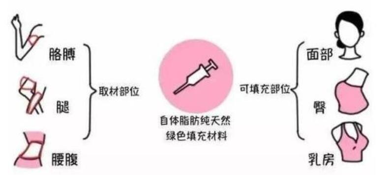 自體脂肪豐臀手術(shù)步驟原理