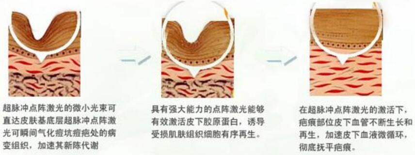 點(diǎn)陣激光祛痘原理圖