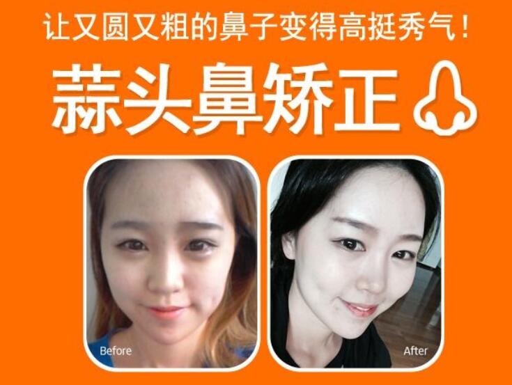 蒜頭鼻整形果圖