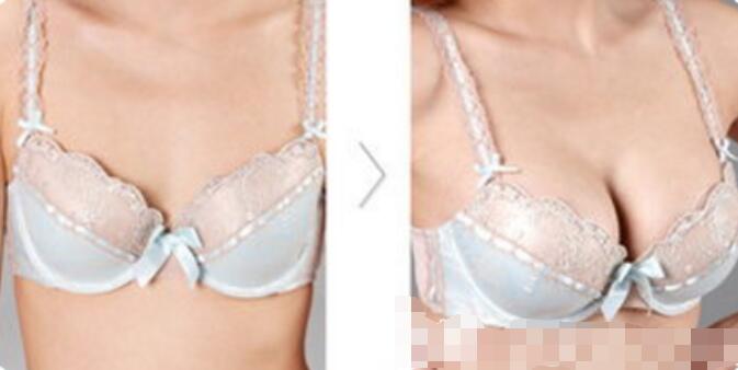 北京伊美爾隆胸案例圖