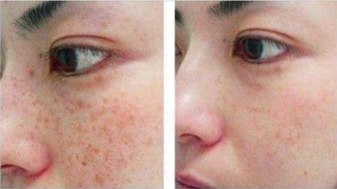 北京協(xié)和醫(yī)院激光祛斑案例