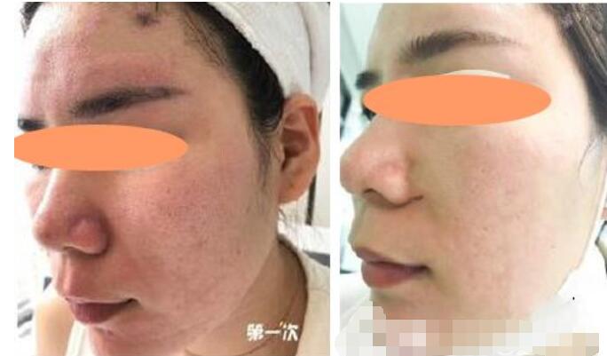 北京協(xié)和醫(yī)院激光祛痘案例