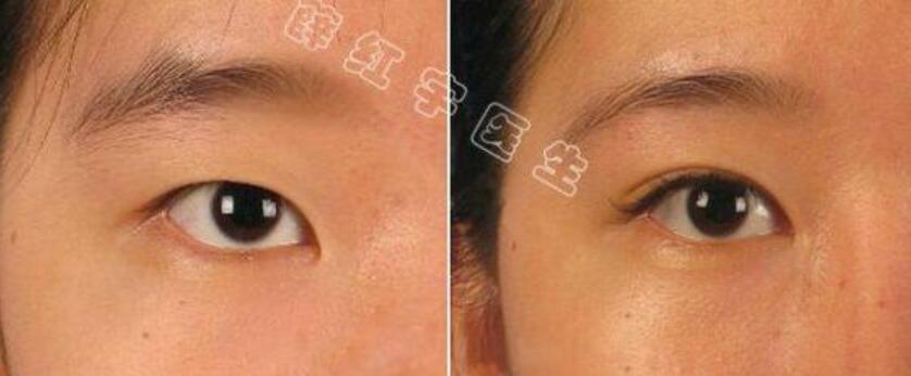 北醫(yī)三院薛紅宇雙眼皮案例圖