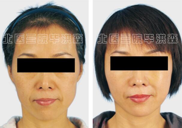 北醫(yī)三院整形外科畢洪森醫(yī)生案例圖
