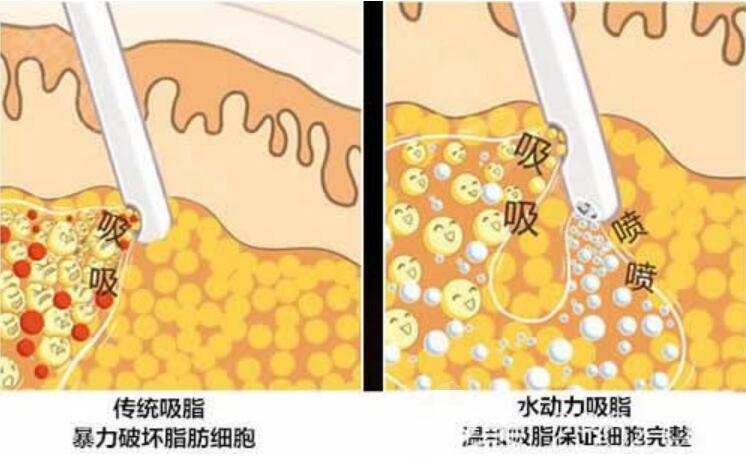 水動力吸脂和傳統(tǒng)吸脂術(shù)對比