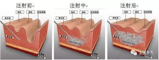 玻尿酸瘦臉？玻尿酸竟然有這個(gè)奇妙的作用？