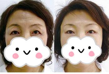 提眉手術(shù)前術(shù)后對(duì)比圖片，提眉手術(shù)和提眉手術(shù)的不同之處~