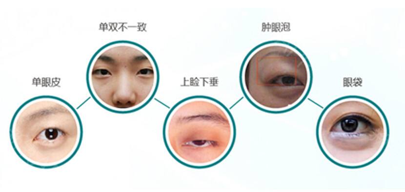 眼睛整形需要多少錢(qián)？眼部整容手術(shù)竟然還涉及這么多種！