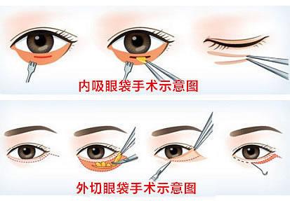 眼睛整形需要多少錢(qián)？眼部整容手術(shù)竟然還涉及這么多種！