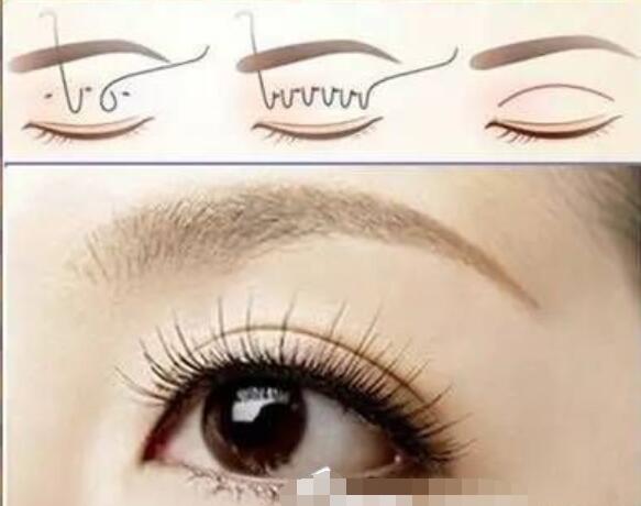 雙眼皮手術(shù)操作步驟
