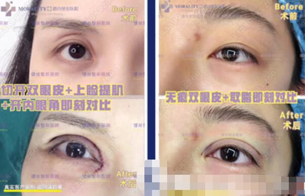 雙眼皮手術(shù)的類型