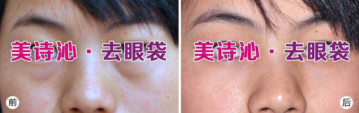 美詩沁去眼袋技術(shù)水平分析，不開刀也可以去眼袋~
