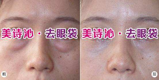 美詩沁去眼袋技術(shù)水平分析，不開刀也可以去眼袋~