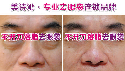 美詩沁去眼袋技術(shù)水平分析，不開刀也可以去眼袋~