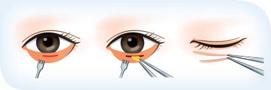 內(nèi)路去眼袋多長(zhǎng)時(shí)間能恢復(fù)正常？會(huì)有并發(fā)癥嗎？