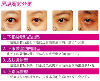 去黑眼圈手術(shù)需要多少錢？手術(shù)要做幾次？