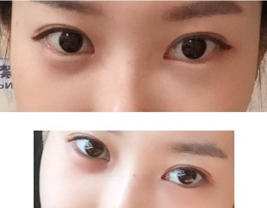 去黑眼圈手術(shù)需要多少錢？手術(shù)要做幾次？