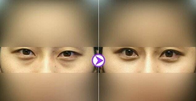 去黑眼圈手術(shù)需要多少錢？手術(shù)要做幾次？