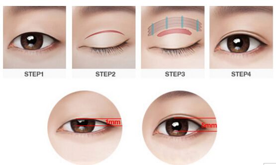 做雙眼皮需要多少錢(qián)？選擇一個(gè)知名度高的的醫(yī)師價(jià)錢(qián)貴嗎？