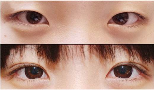 做雙眼皮需要多少錢(qián)？選擇一個(gè)知名度高的的醫(yī)師價(jià)錢(qián)貴嗎？