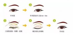 做完全切后感染了怎么辦？補救雙眼皮小妙招