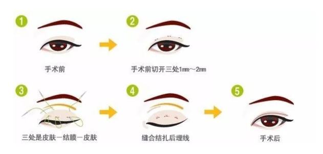 做完全切后感染了怎么辦？補(bǔ)救小妙招