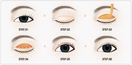 做完全切后感染了怎么辦？補(bǔ)救小妙招