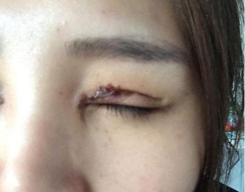 做完全切后感染了怎么辦？補(bǔ)救小妙招