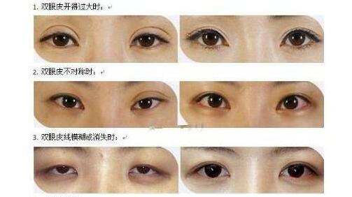 做了雙眼皮手術(shù)后還能做近視眼矯正術(shù)嗎？當(dāng)然可以啦