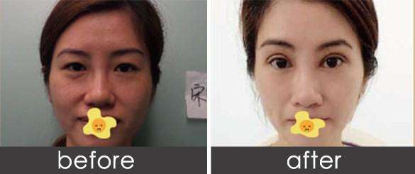 微創(chuàng)雙眼皮是如何做的？果能保持多長時(shí)間？