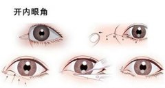 韓式開眼角整容手術(shù)術(shù)后康復(fù)時間及注意事項