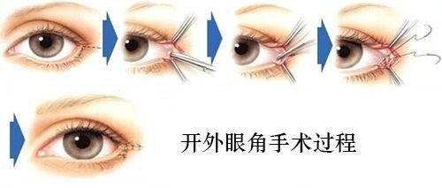 韓式開眼角整容手術(shù)術(shù)后康復(fù)時間及注意事項