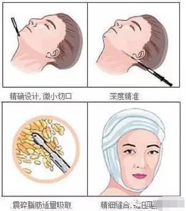 面部吸脂手術(shù)原理圖